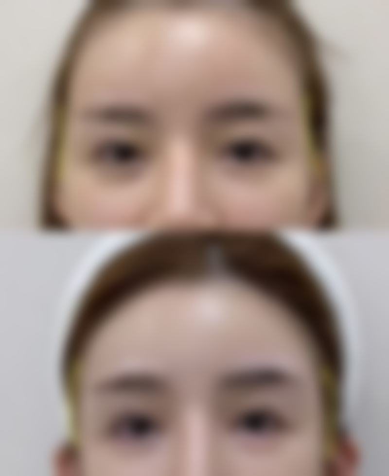 黄金超声炮：改善肤质的小能手