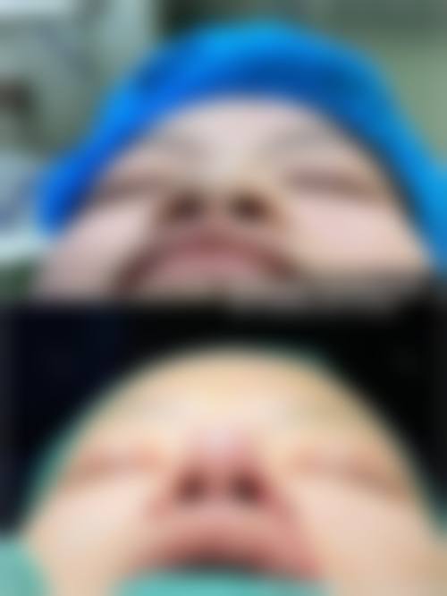 梁彦华眼部整形实例