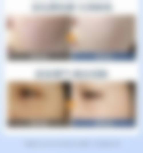 国晶激光治疗面部色斑水平怎么样可靠吗？