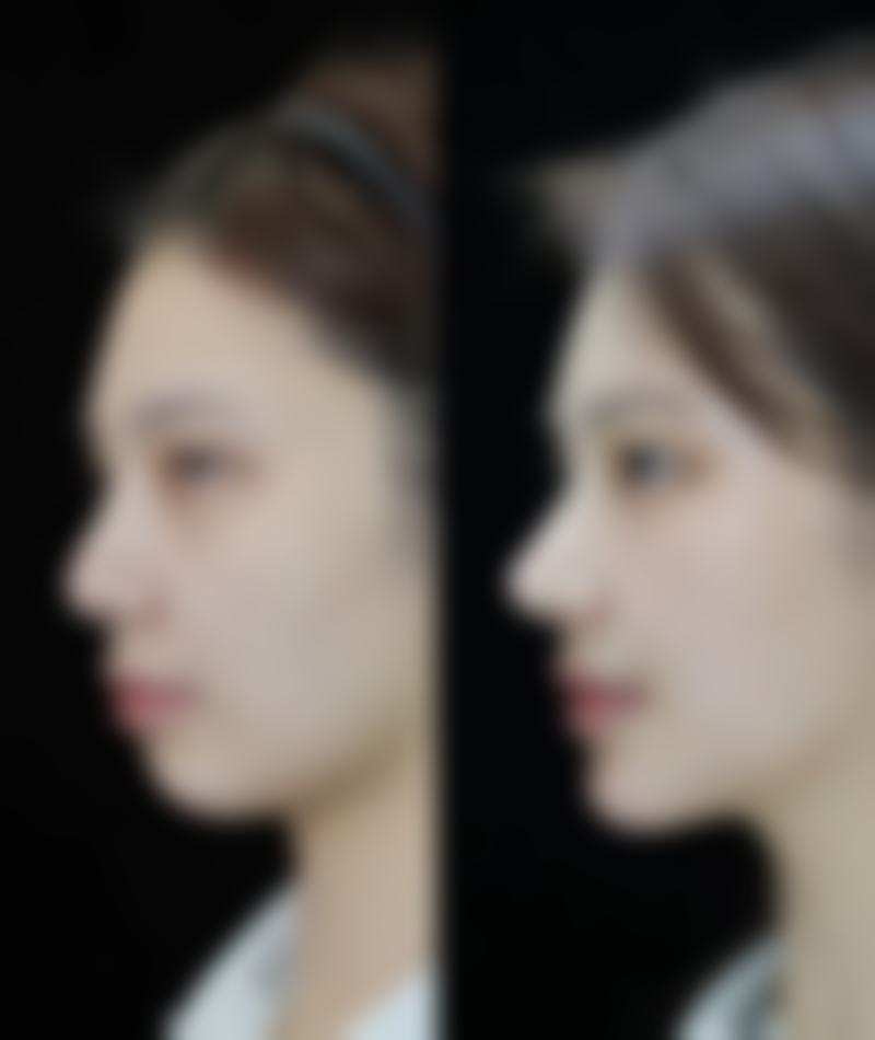 方国军眼部整形水平怎么样可靠吗？