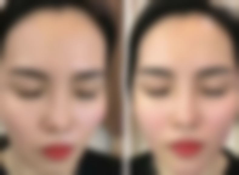 国晶激光治疗面部色斑实例