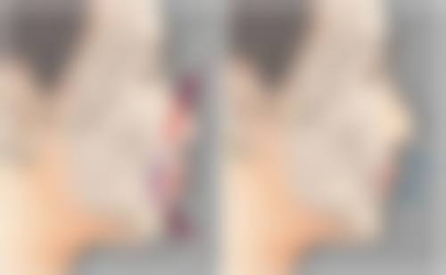 抽脂修复阶段的注意事项