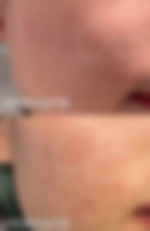 得了疤痕疙瘩别发愁，综合治疗解您忧