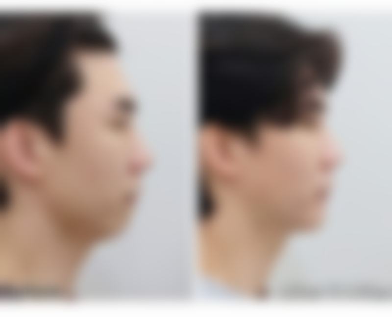 得了疤痕疙瘩莫担忧，激光治疗有一手