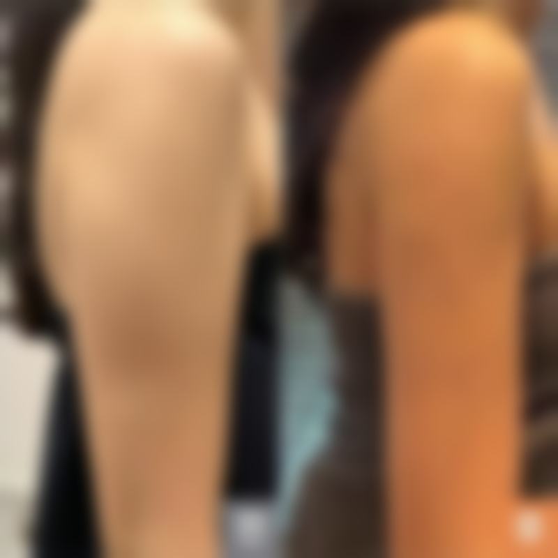 假体隆胸后能否用力抓？聊聊假体隆胸的那些优势