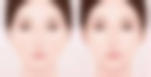 轻医美助力，进一步改善眼袋问题