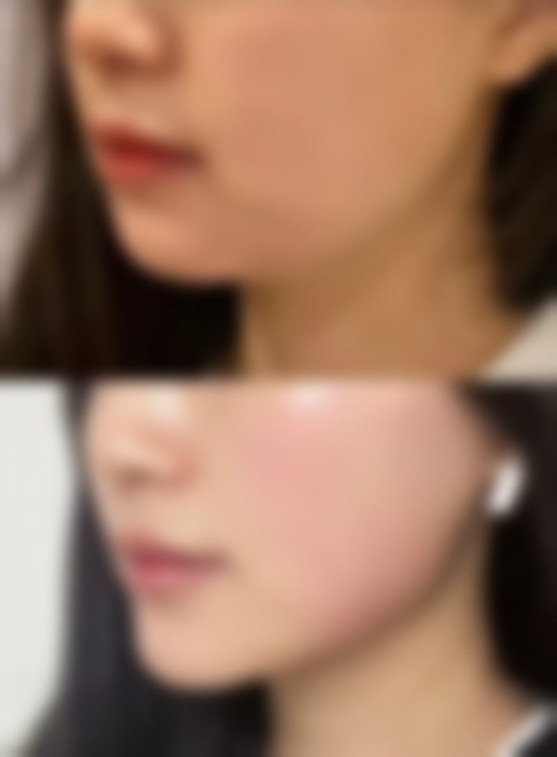 怎样通过非手术方法去除眼袋?轻医美来帮忙