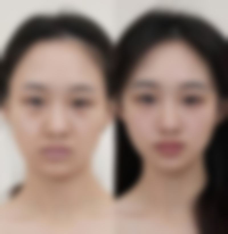 假体隆胸喂奶是否下垂？不同情况差异大