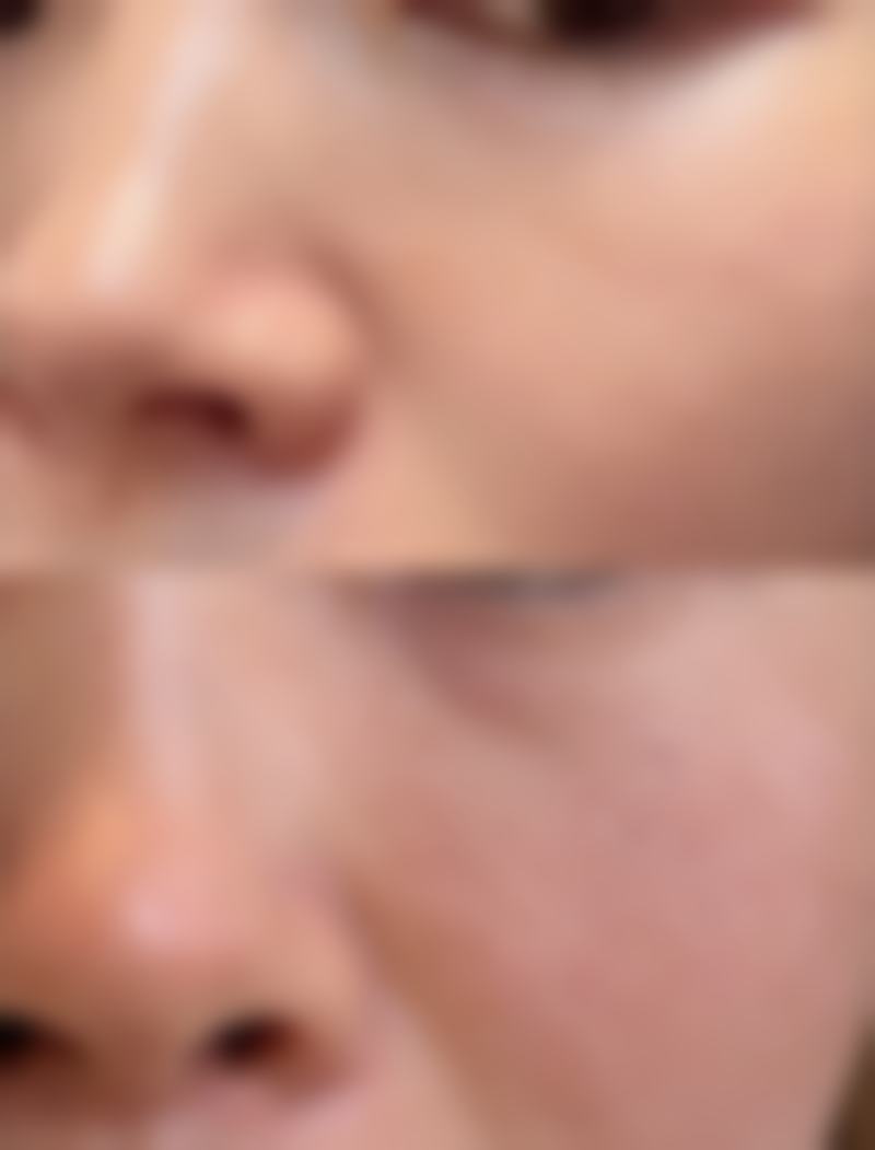 疤痕长疙瘩原因大揭秘：多维度预防疤痕疙瘩