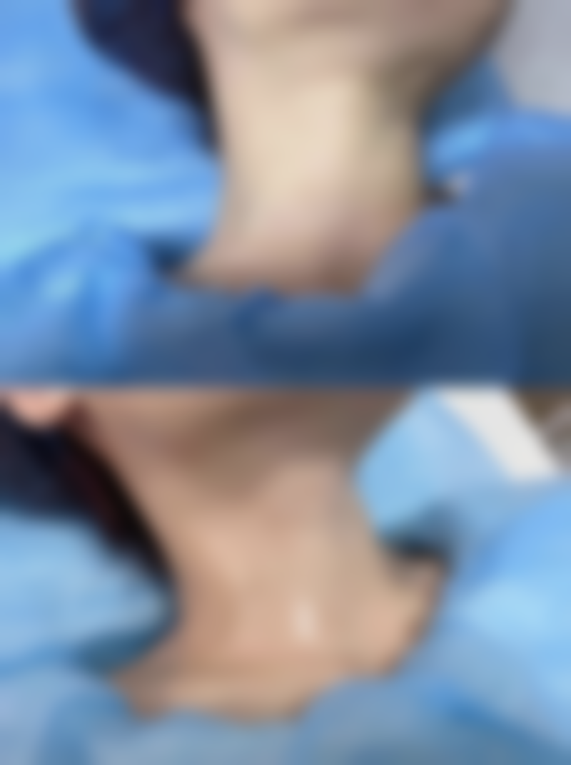 肚子抽脂潜在危害大揭秘：凹凸不平、感染风险及正规医院应对策略 