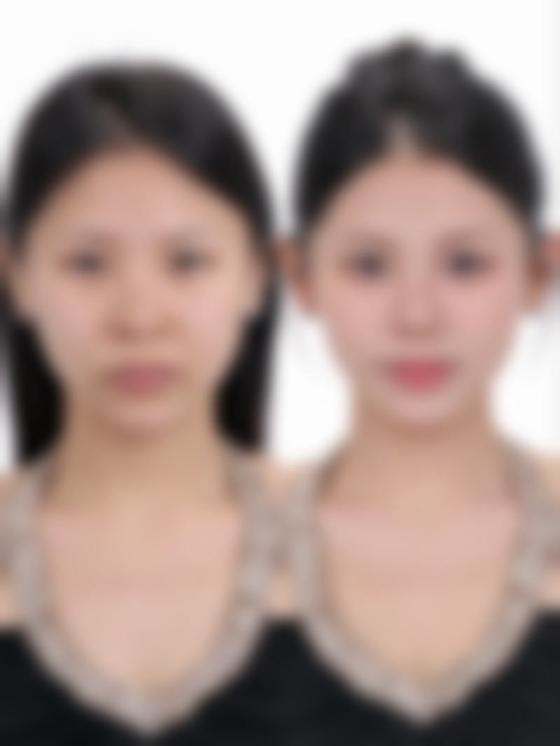 揭秘：眼袋与眼睑并非同一部位，医院多维度方案助您改善眼部形态问题！ 