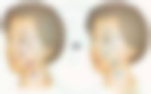 割完双眼皮后多久能碰水洗脸？5 - 7 天合理安排，加速恢复还防感染 