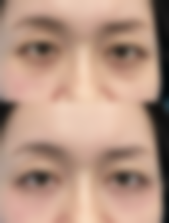 祛眼袋成效大揭秘：改善眼部外观，提升整体容貌