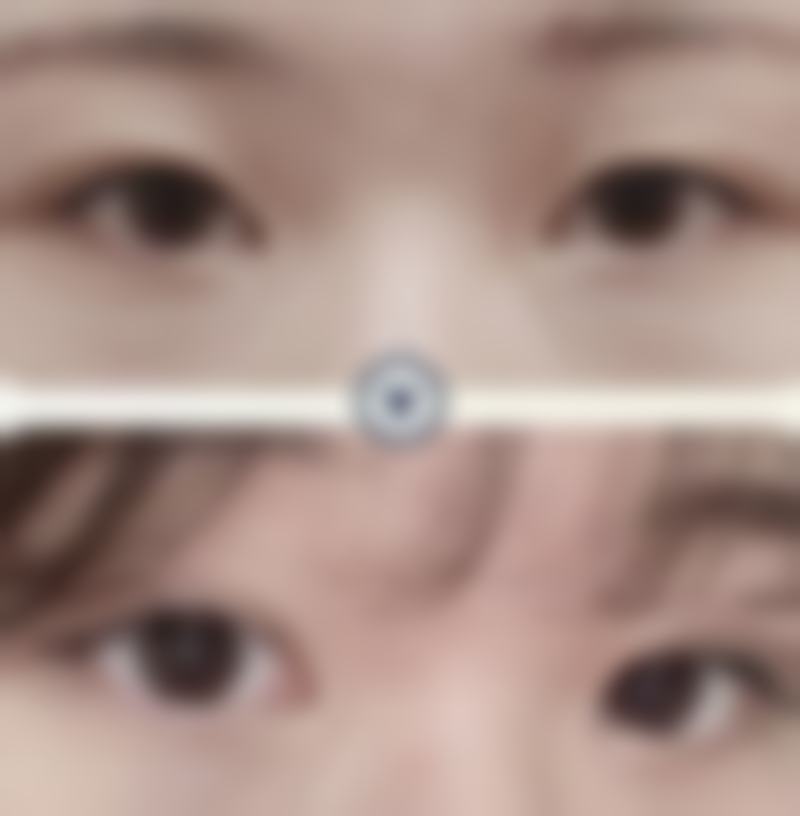 刘文慧眼部整形水平怎么样可靠吗？