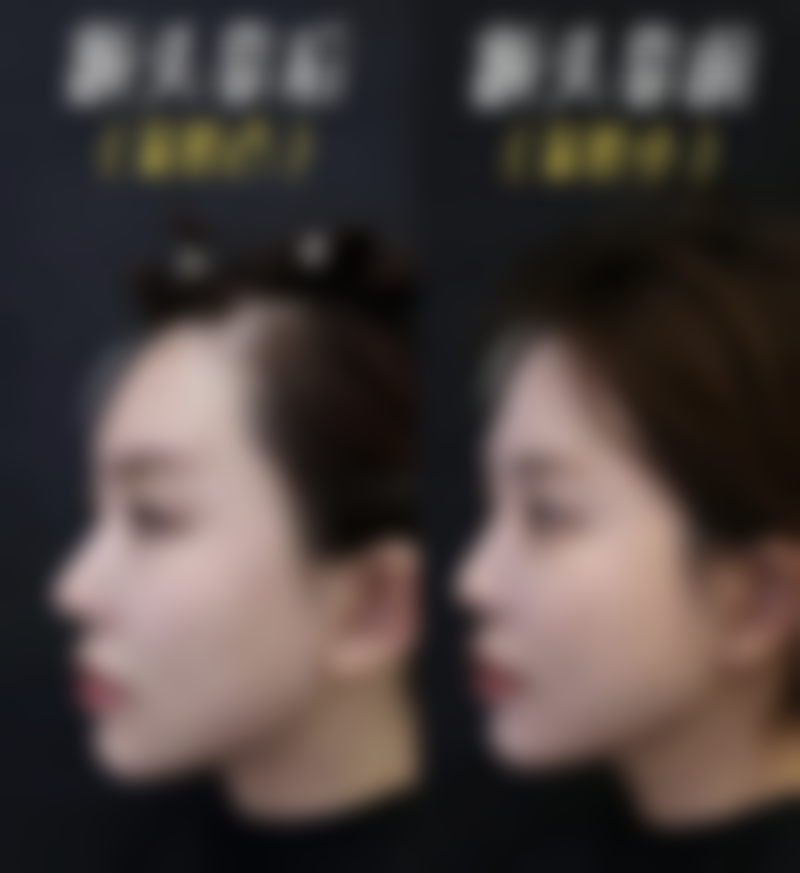 祛眼袋成效大揭秘：减轻眼部疲劳感，提高生活质量