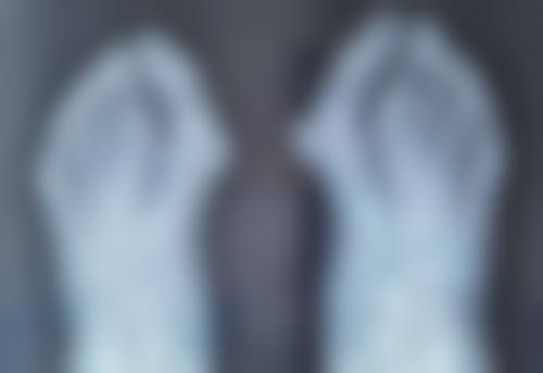 身体肥胖是否适合抽脂？了解适用情况、风险与恢复，开启健康塑形之旅 