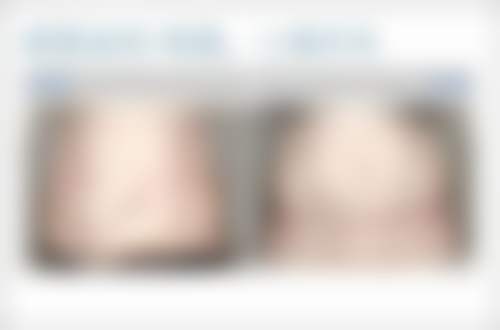 手术去眼袋恢复期究竟要多久？公立三甲医院技术助力，短恢复期优势显著！ 