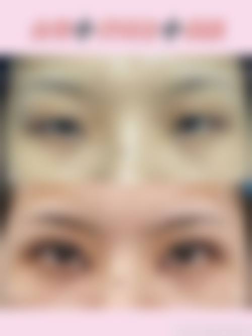 刘文慧眼部整形水平怎么样可靠吗?