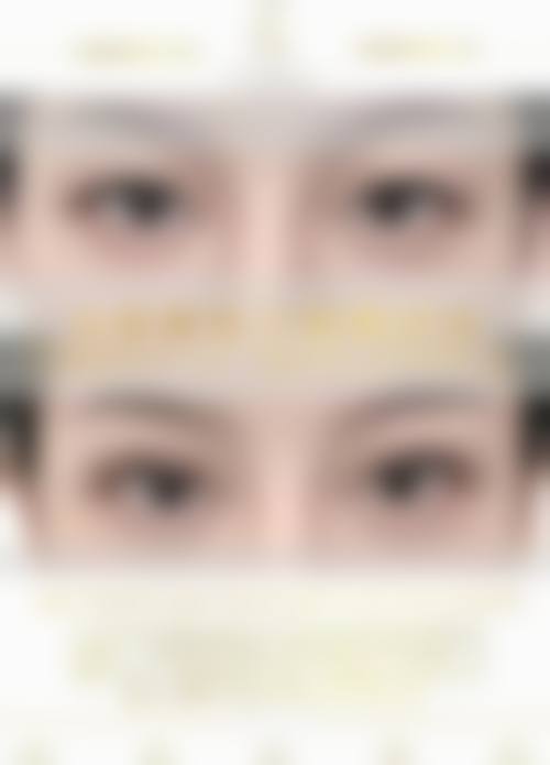 刘文慧眼部整形水平怎么样可靠吗?