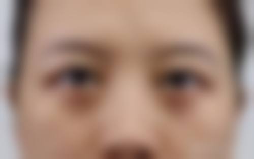 刘文慧眼部整形实例