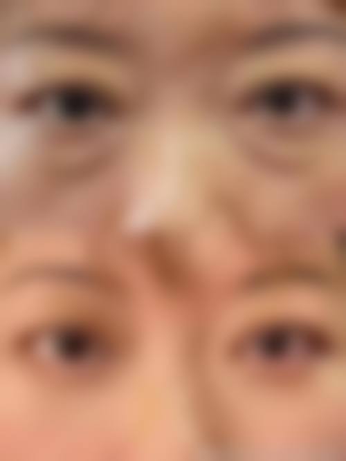 刘文慧眼部整形水平怎么样可靠吗？