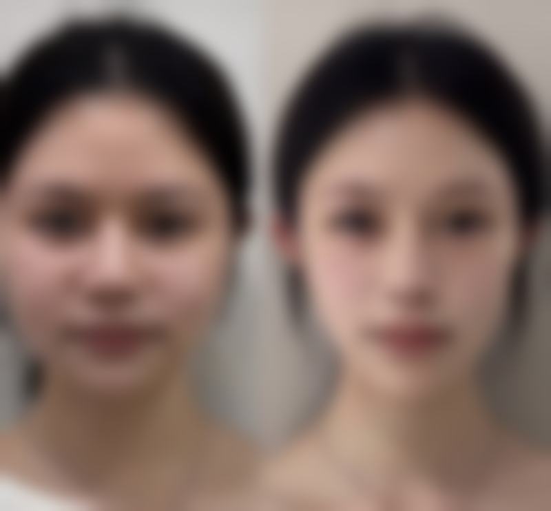 手术去眼袋修复期：价格与性价比