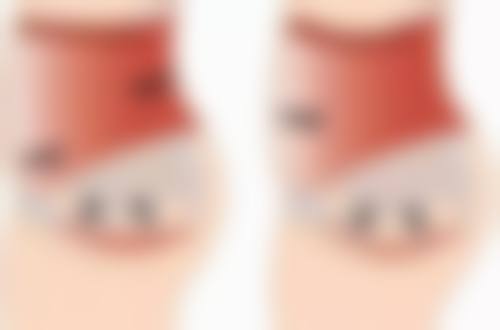 医美手段：快速去除黑眼圈和眼袋的利器