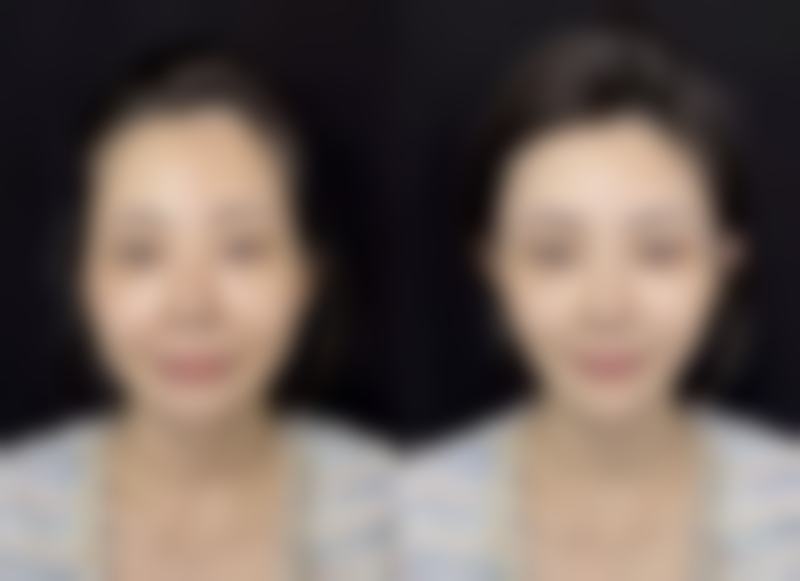 美学修复,让胸部依旧美丽