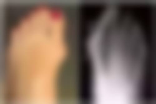 吸脂修复的不同阶段表现