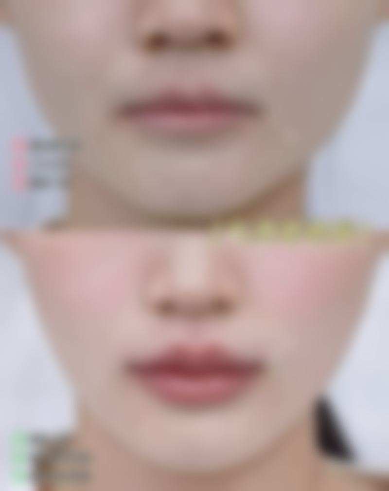 个人体质对吸脂修复时间的影响