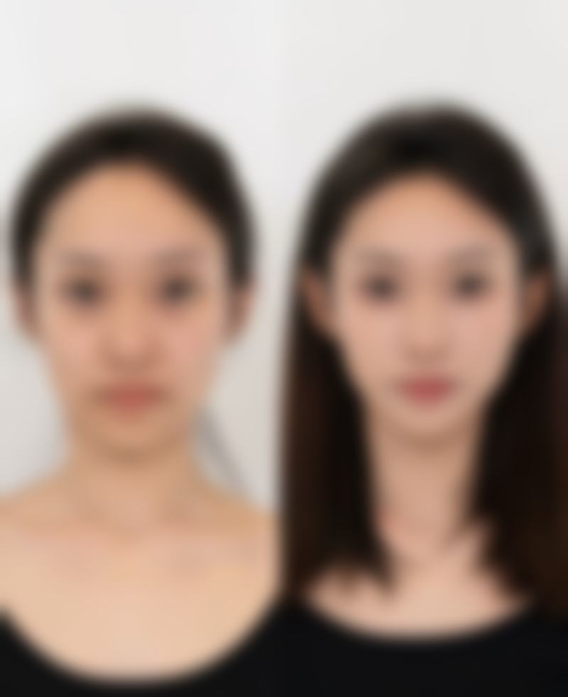 轻松告别黑眼圈黑眼袋！多维度方案+专业医美助力，还你明亮双眸 