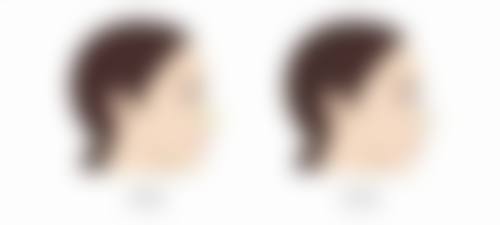 熬夜导致的黑眼圈眼袋怎么去除？生美医美结合方案，助你逐步恢复眼周健康 