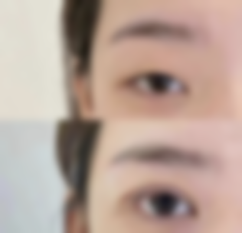 硅胶与膨体术后情况大比拼，谁的“售后”更省心