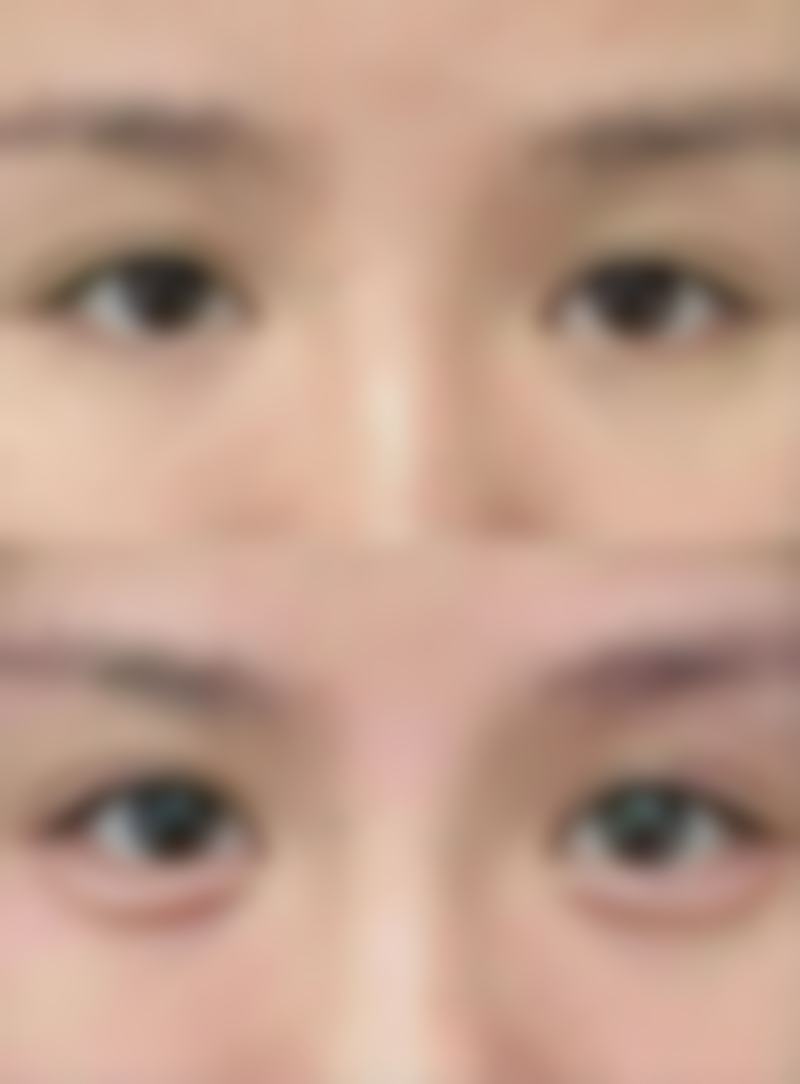 何时隆胸更适宜？不同丰胸方式的时机选择