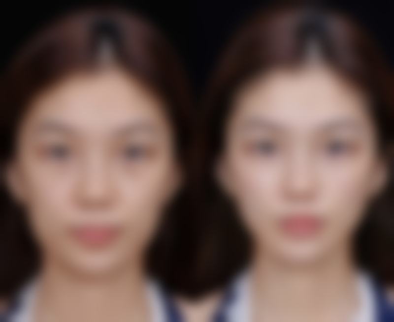 夏天割眼袋可行吗？短修复期打造明亮年轻双眸