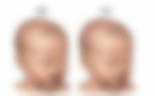 心脏不好也想做眼袋手术？专业评估+风险把控助您安全实现眼部年轻化