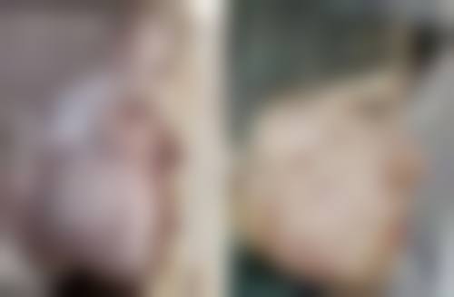 加速大腿吸脂消肿的护理建议