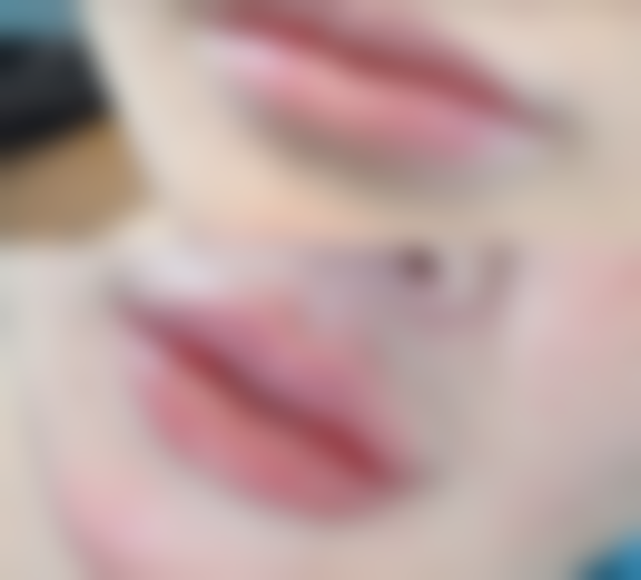 与其他去眼袋方法对比:线提升优势明显