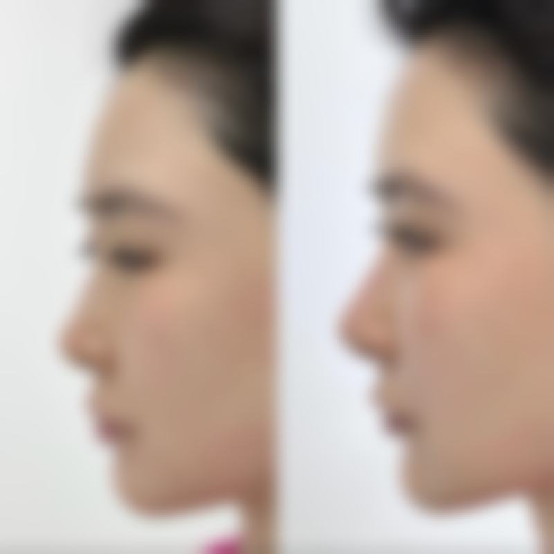 眼袋周围有皱纹怎么办?选对正规医院特别重要