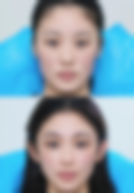 面部吸脂多久见成效？选择合适的医院特别重要