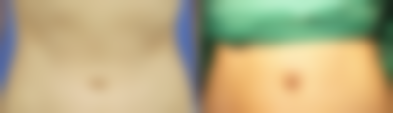 埋线双眼皮术后大小眼是正常现象吗？答案揭晓，助你正确应对与改善 