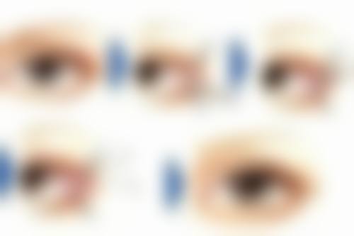 眼袋贴能否去除眼袋？科学应对不同类型眼袋