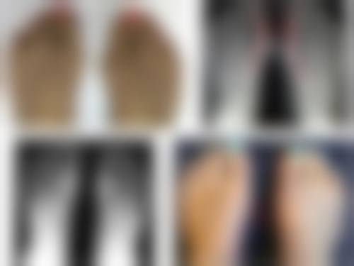 早上双眼皮变单眼皮，原因之过敏或炎症反应揭秘