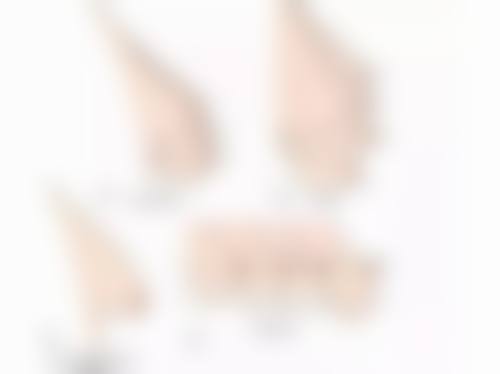 医美上阵，多种方案精细去除39岁眼袋