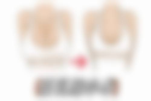 玻尿酸注射除皱成效棒？自然度关键得把握好！