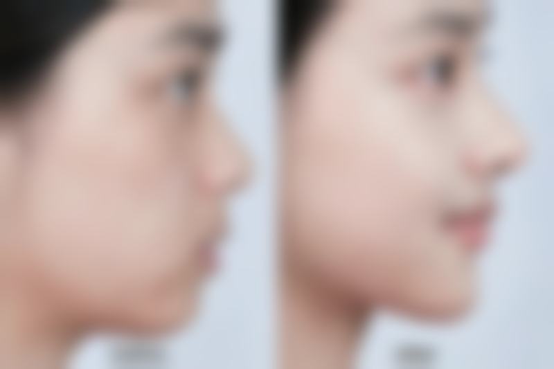 早上双眼皮变单眼皮咋回事？原因大揭秘及正规医院医美改善方案呈现 