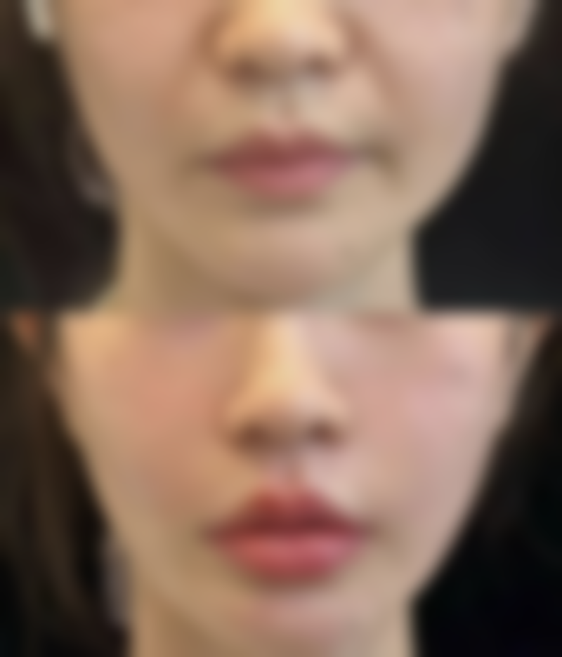 玻尿酸注射除皱成效棒？联合方案攻克动态纹难题！