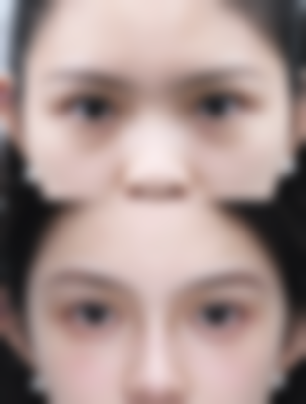 不同麻醉方式对割完双眼皮后怀孕时间的影响