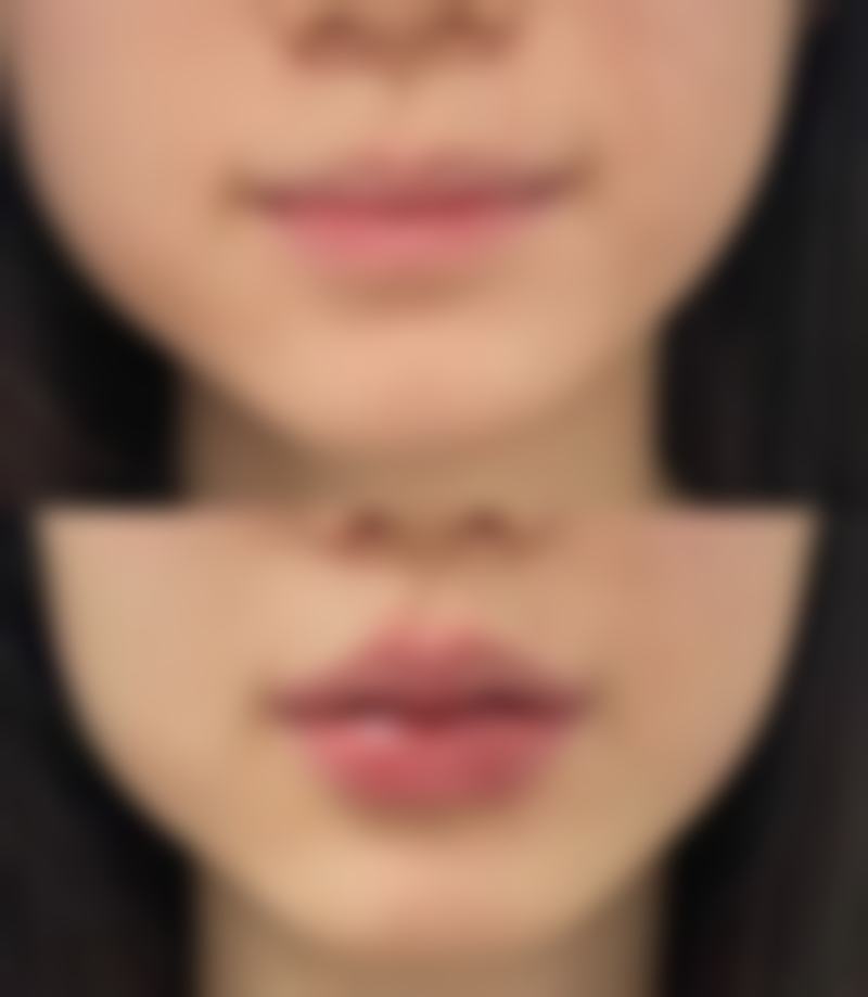 双眼皮下垂不用愁，提眉、双眼皮手术与热玛吉提升，多法助你重塑明亮双眸 