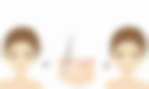 全切双眼皮疤痕修复选什么？硅酮凝胶、祛疤贴等助你淡化疤痕焕新生 